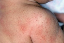 rashes